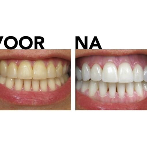 Tandenbleekset voor en na review foto