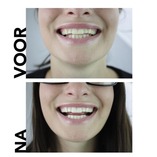 natuurlijke tanden die tandpasta voor en na bleken